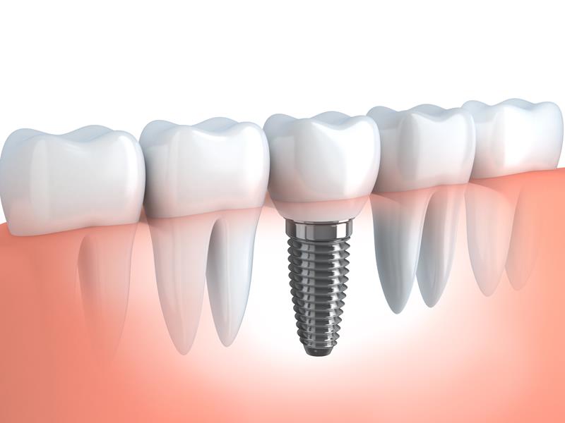Dental Implants  Jamestown, TN 