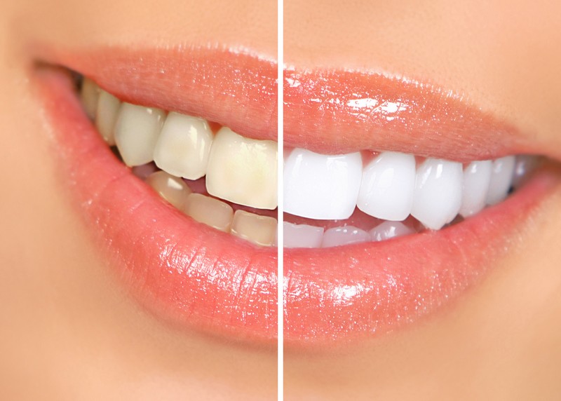 Teeth Whitening  Jamestown, TN 