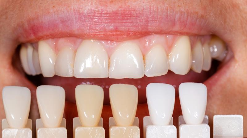 Veneers Jamestown, TN